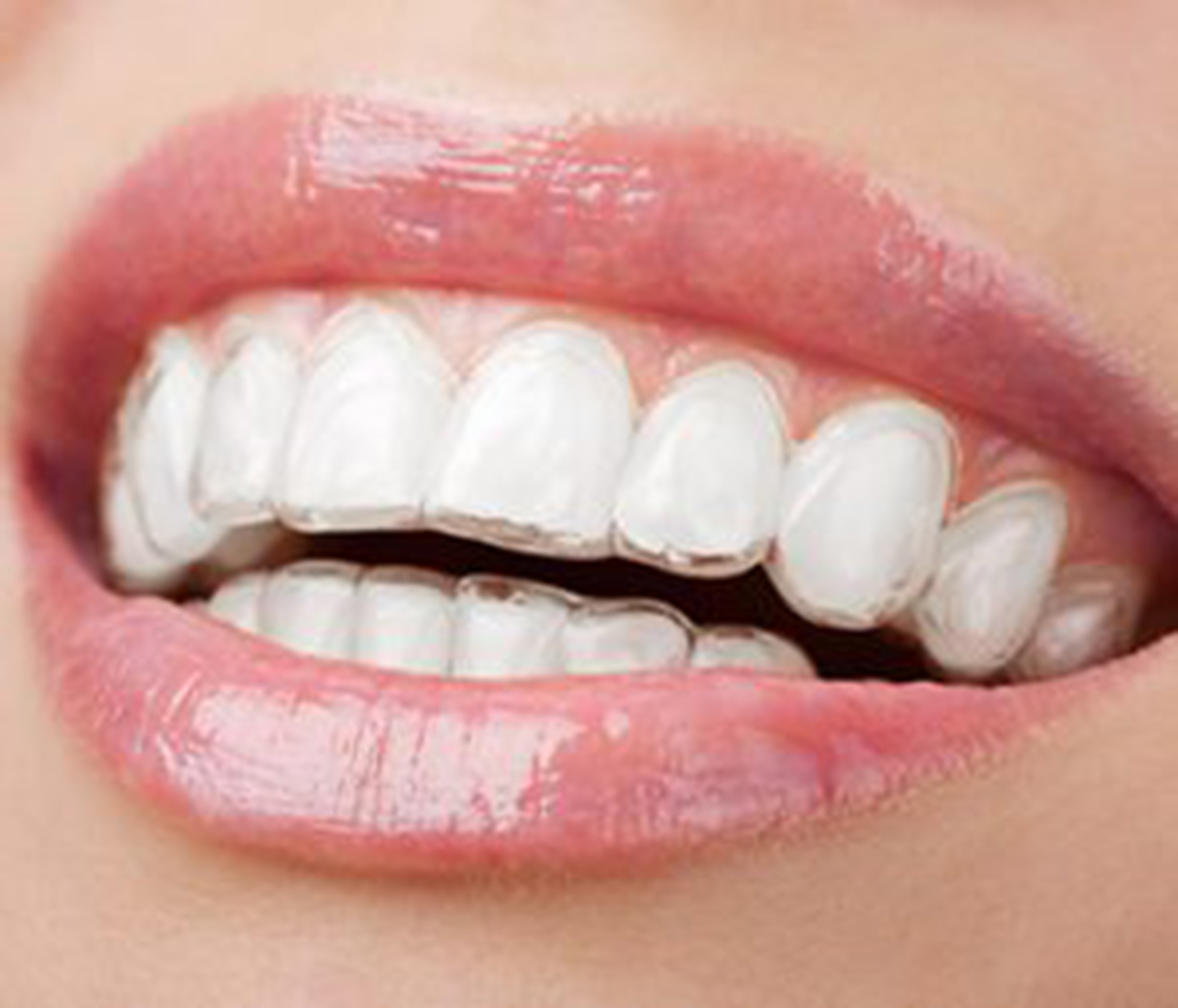 Clear Braces Cost in Knoxville