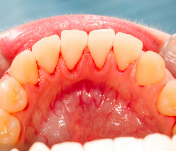 Why should Farragut area patients seek treatment for their gingivitis?