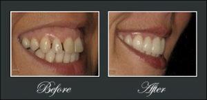 Before and After Veneers