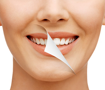 Why Knoxville area patients should choose professional whitening