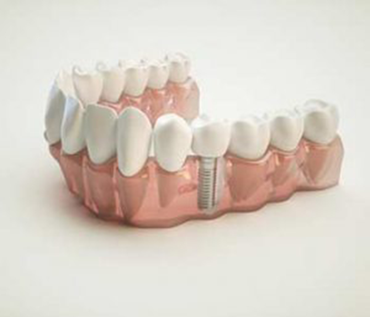 3D image of a Dental Implant