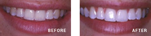 Teeth whitening Before After Image