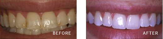 Cosmetic Dentistry Before After