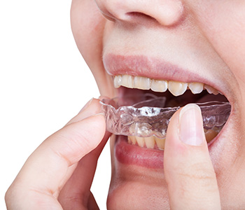 Invisalign Orthodontic Treatment in Knoxville area