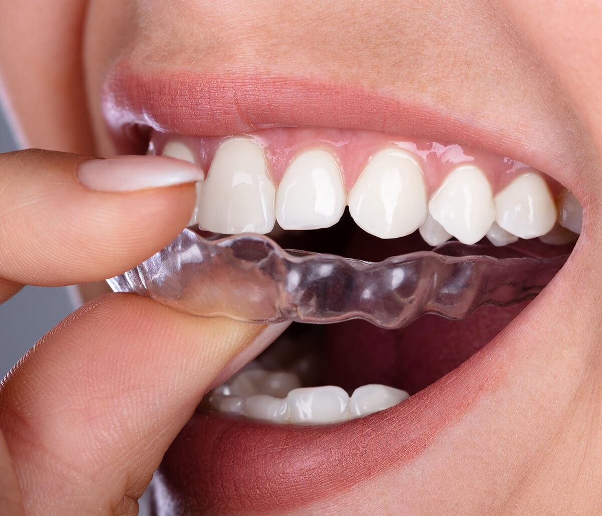 Invisalign® is a great value and alternative to braces for comfortable, precise treatment