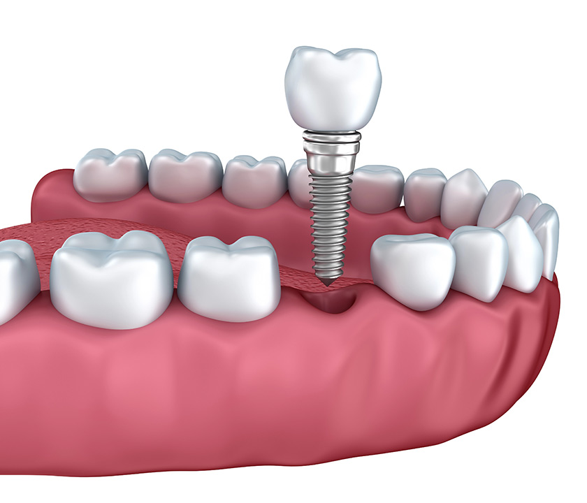 Dental Implants For Missing Teeth in Knoxville TN Area