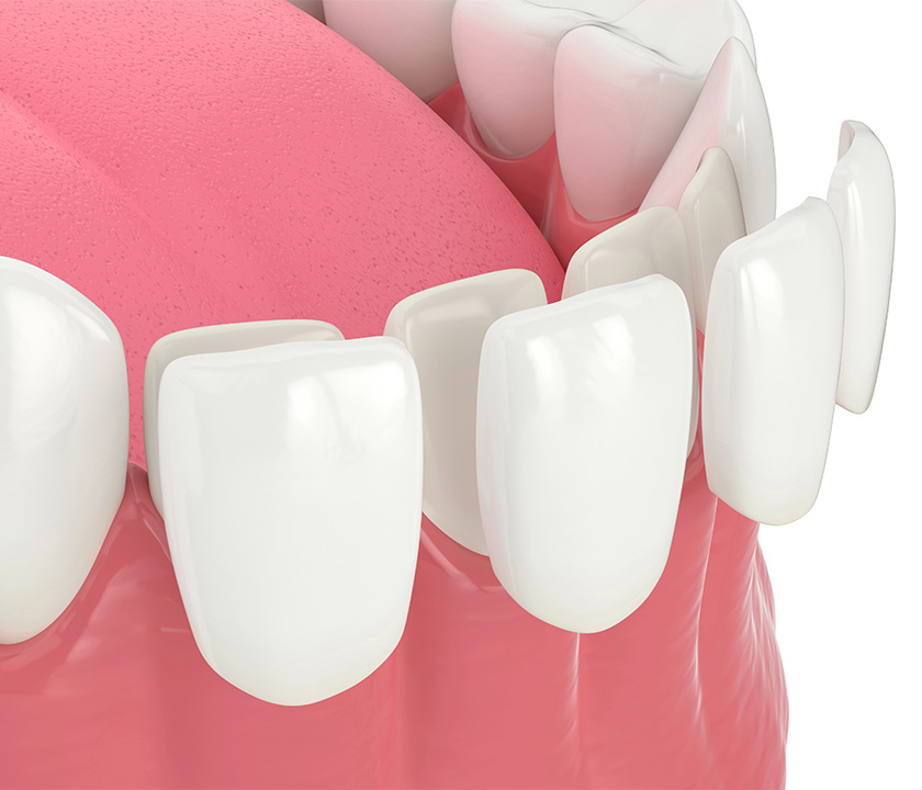 Porcelain Veneers Procedure in Knoxville TN Area