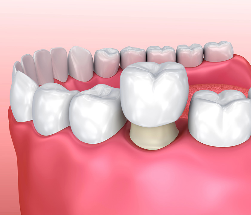 Protect Teeth With Dental Crowns in Knoxville TN Area