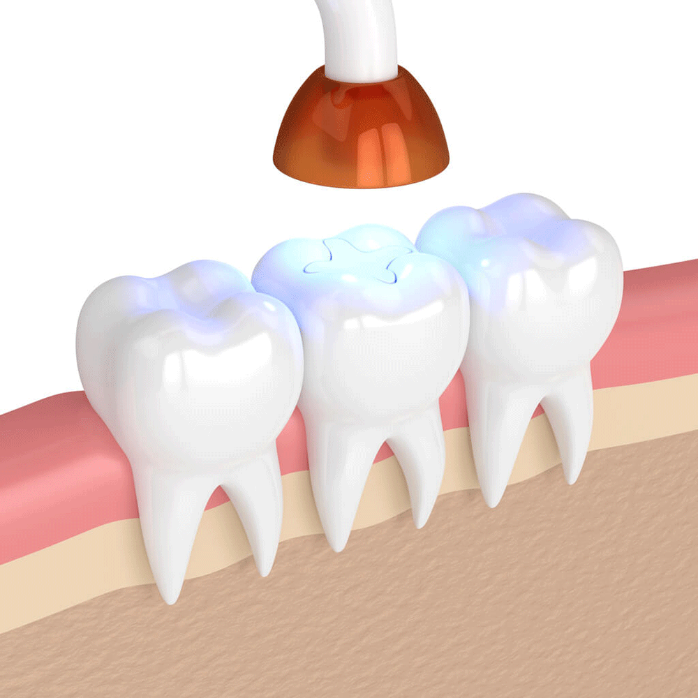 Cavity Fillings and Dental Sealants