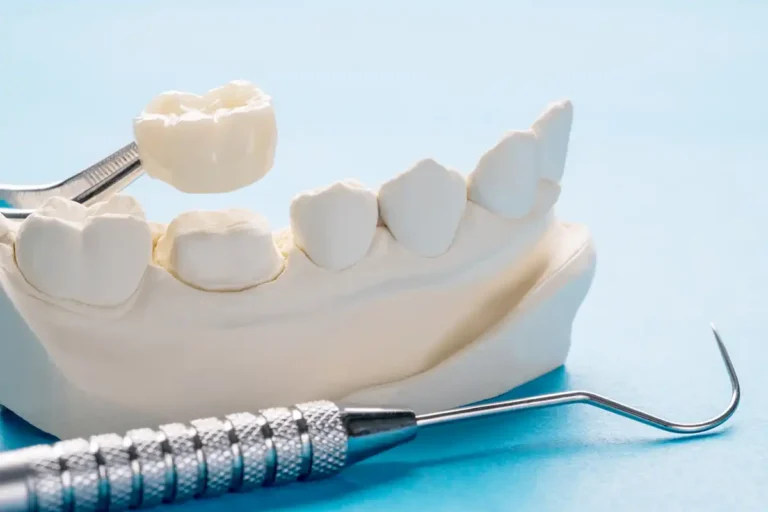 dental crown sketelon model